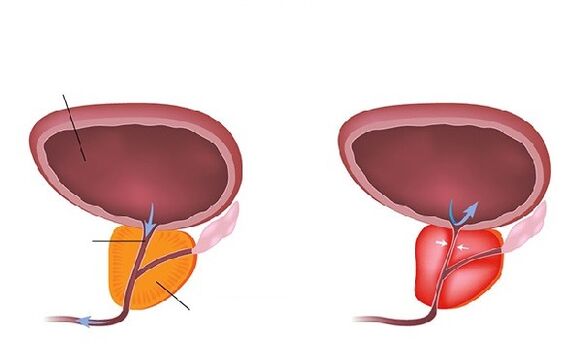 φυσιολογικός και φλεγμονώδης προστάτης